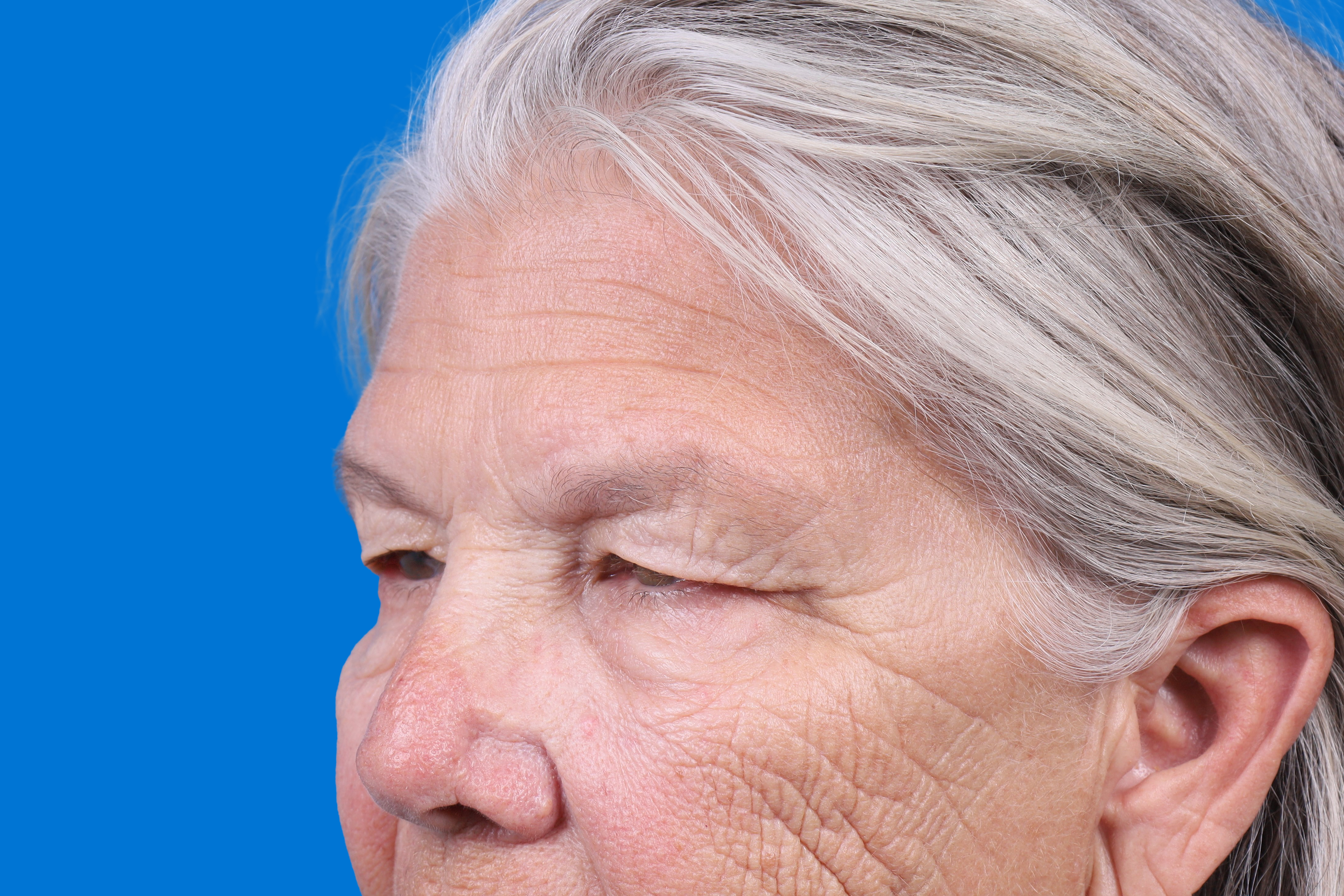 Eyelid Surgery Before & After Gallery - Patient 216425 - Image 5