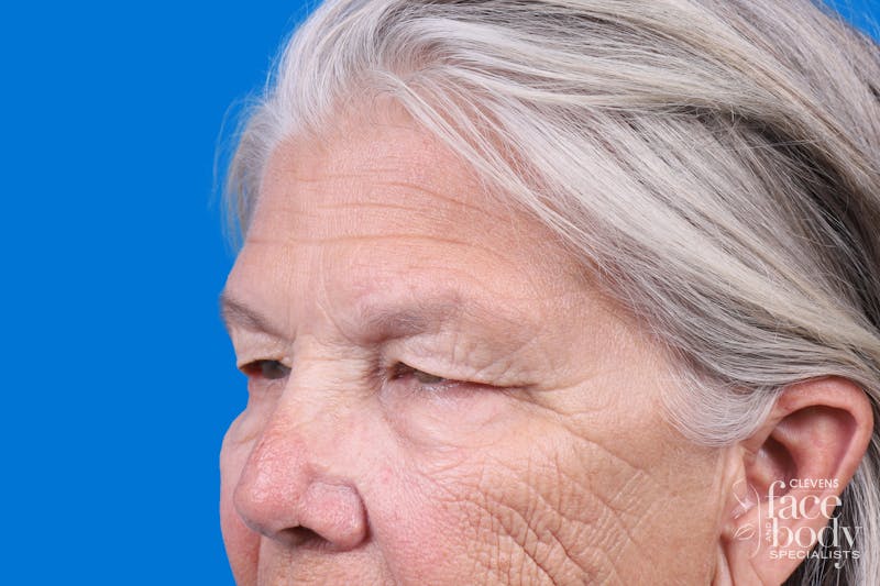 Eyelid Surgery Before & After Gallery - Patient 216425 - Image 5