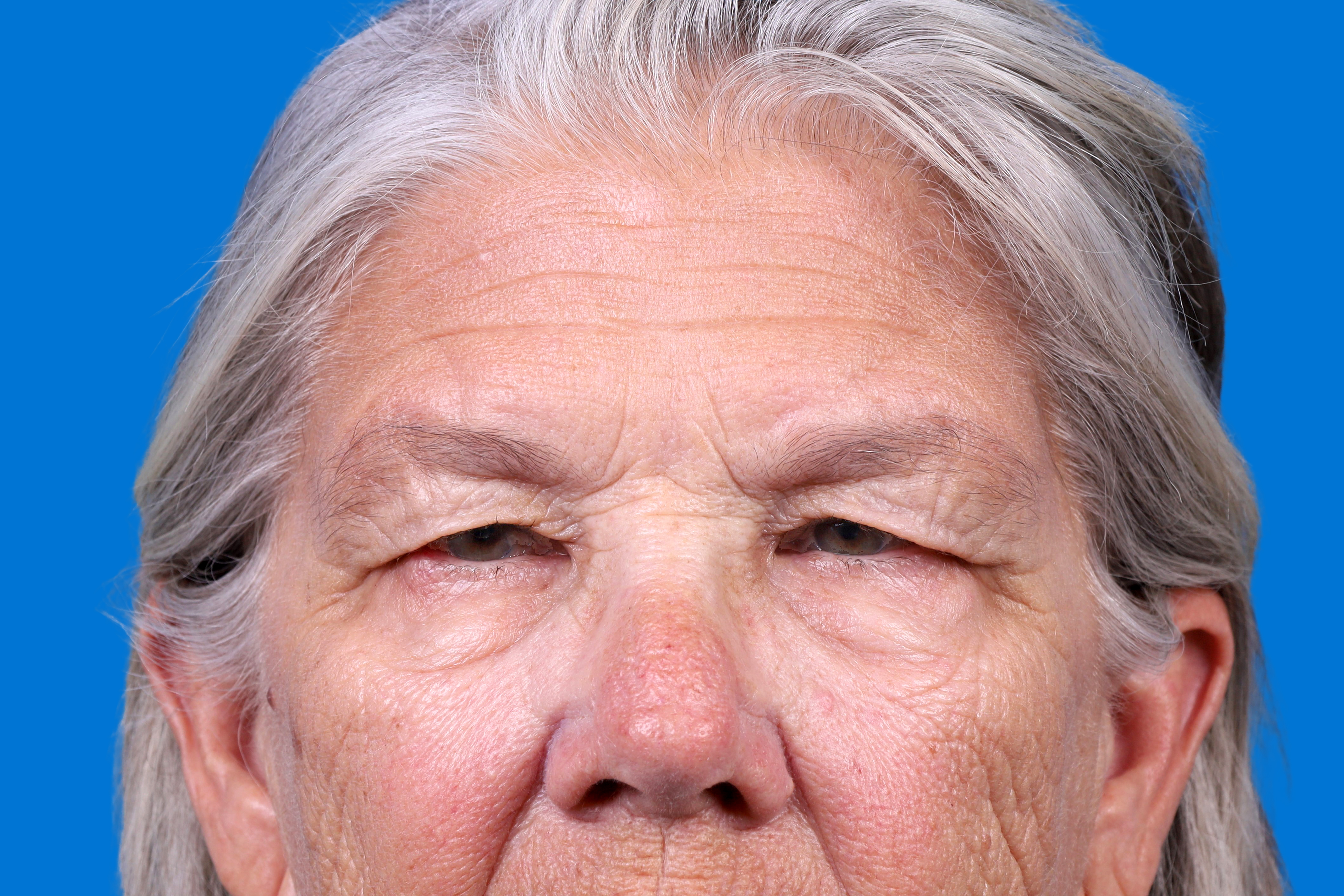 Eyelid Surgery Before & After Gallery - Patient 216425 - Image 1