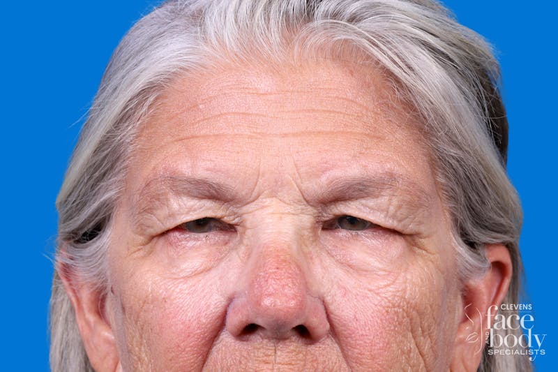 Eyelid Surgery Before & After Gallery - Patient 216425 - Image 1