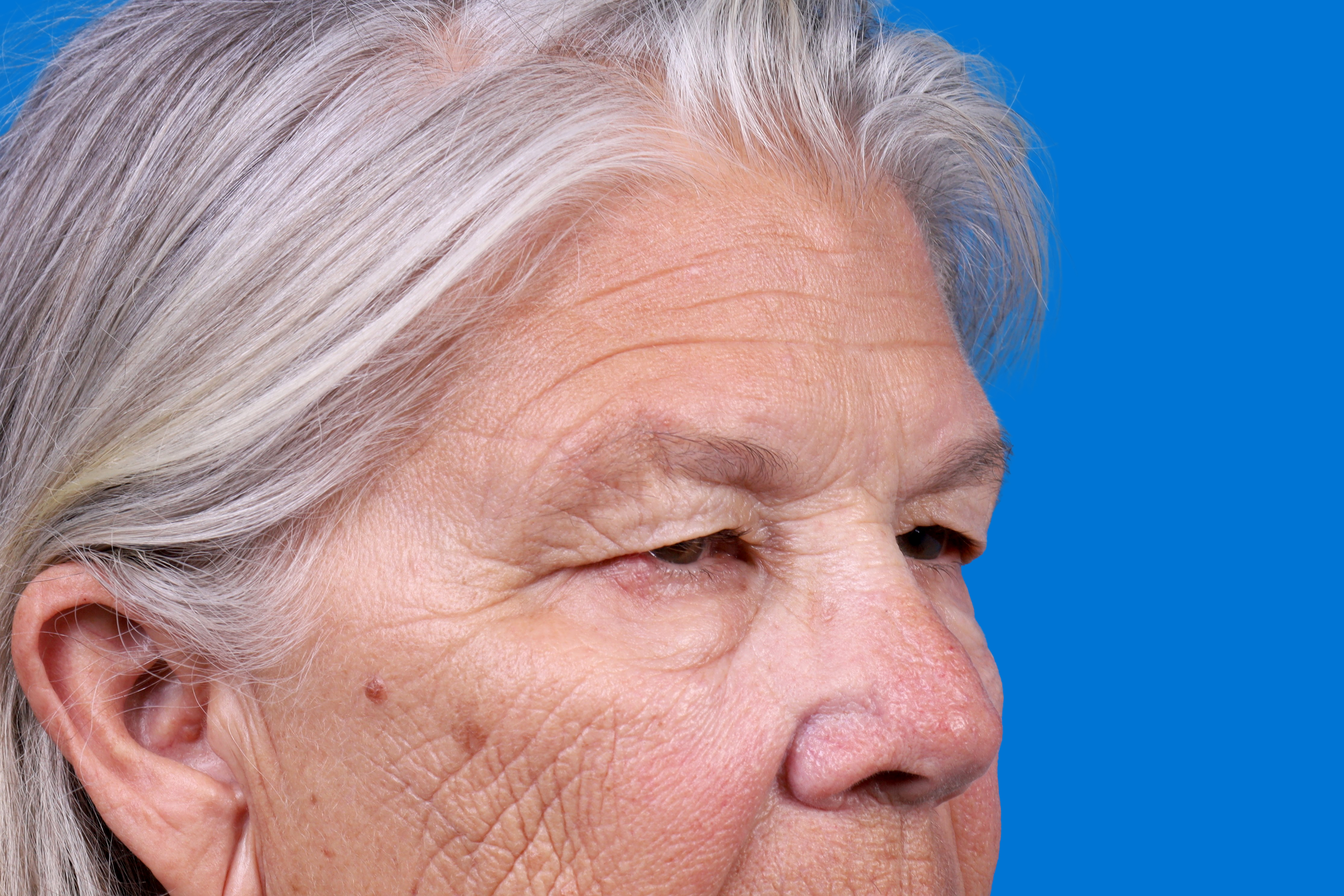 Eyelid Surgery Before & After Gallery - Patient 216425 - Image 3