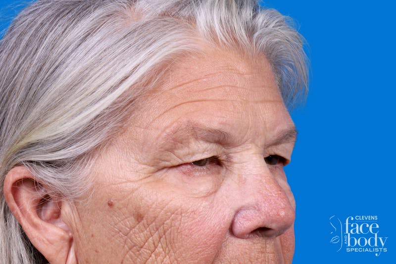 Eyelid Surgery Before & After Gallery - Patient 216425 - Image 3