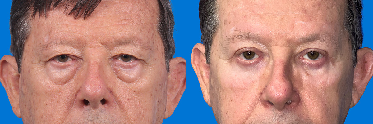 Eyelid Surgery Before & After Gallery - Patient 117650 - Image 1