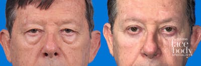 Eyelid Surgery Before & After Gallery - Patient 117650 - Image 1