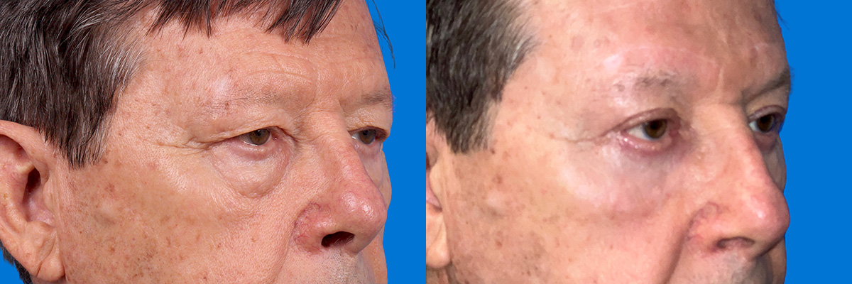 Eyelid Surgery Before & After Gallery - Patient 117650 - Image 2