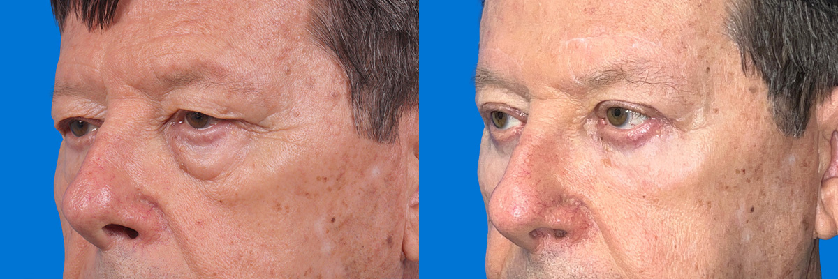 Eyelid Surgery Before & After Gallery - Patient 117650 - Image 3