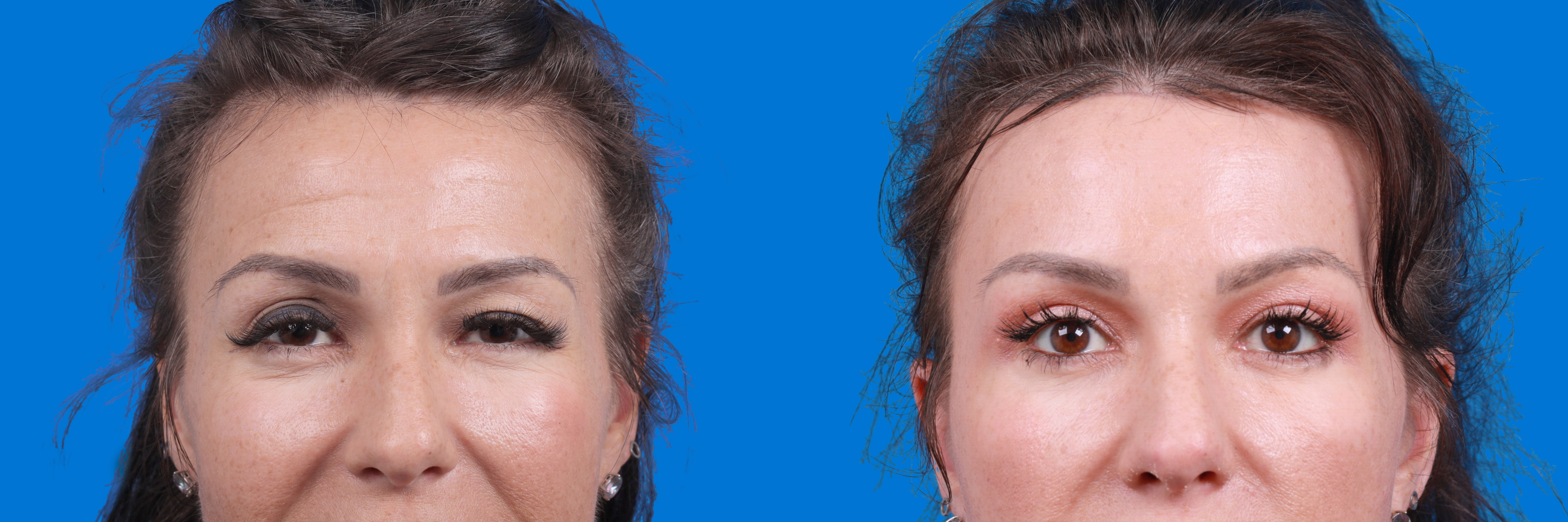 Eyelid Surgery Before & After Gallery - Patient 424518 - Image 1