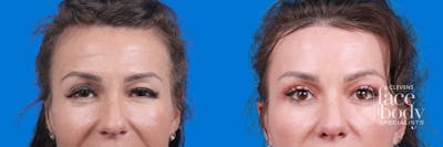 Eyelid Surgery Before & After Gallery - Patient 424518 - Image 1