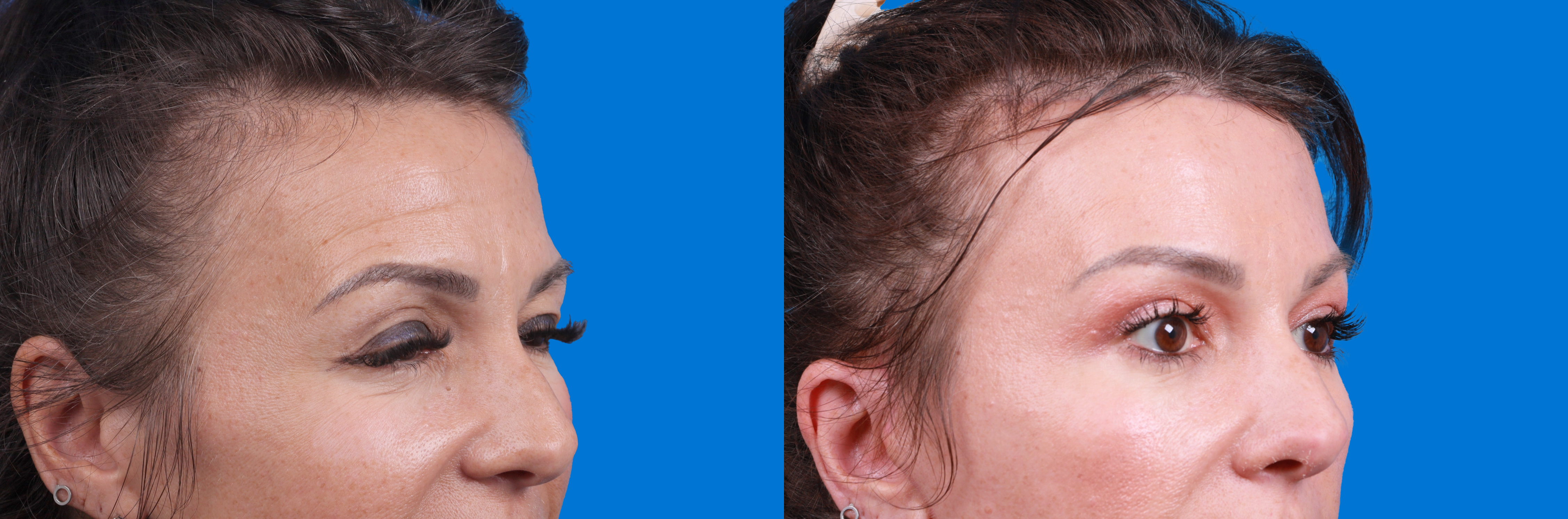 Eyelid Surgery Before & After Gallery - Patient 424518 - Image 2