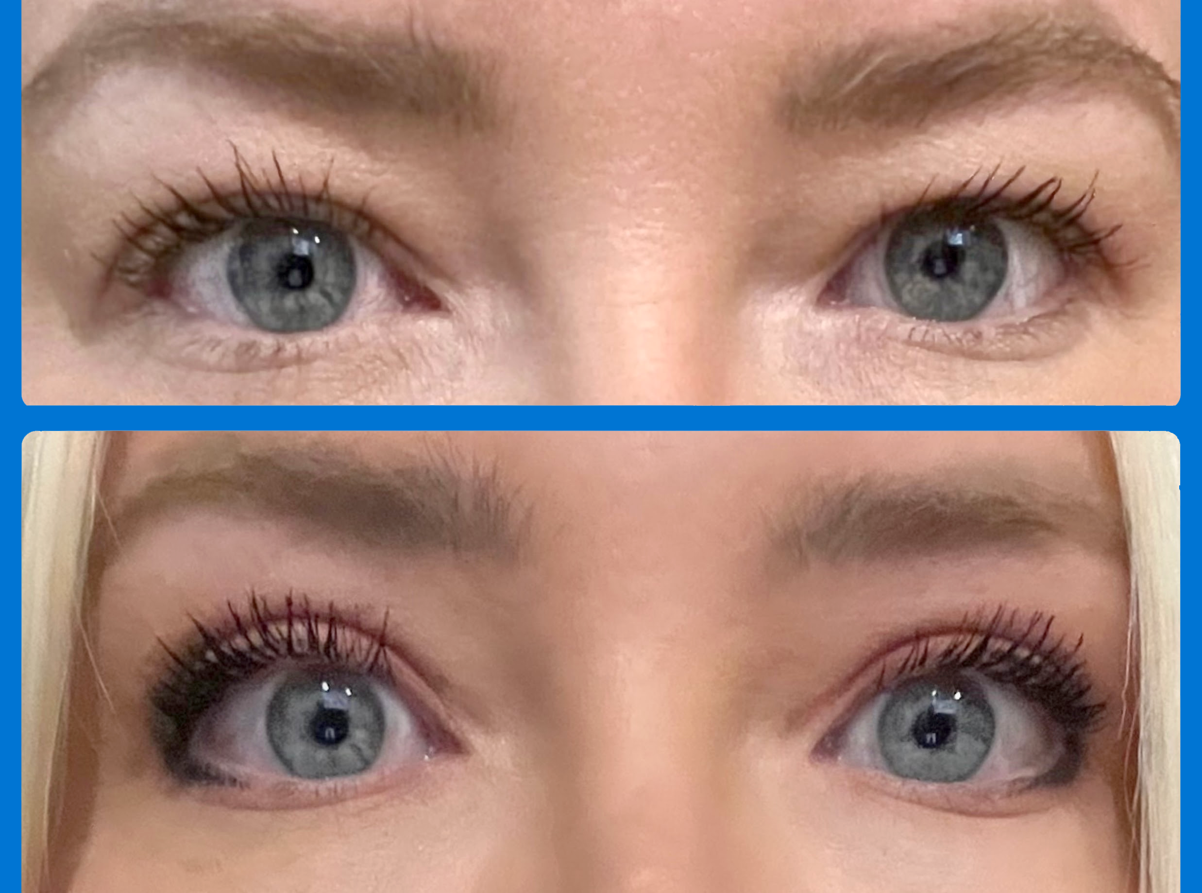 Eyelid Surgery Before & After Gallery - Patient 250007 - Image 2