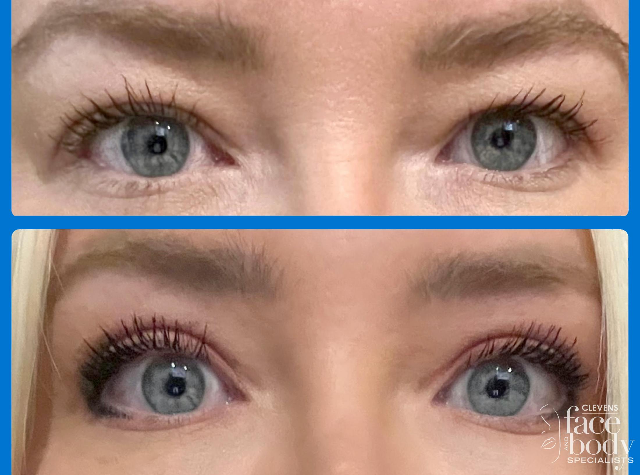 Eyelid Surgery Before & After Gallery - Patient 250007 - Image 1