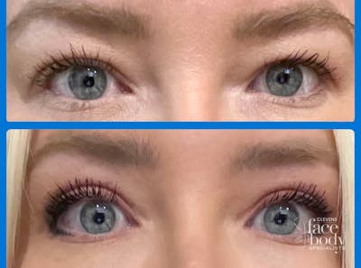 Eyelid Surgery Before & After Gallery - Patient 250007 - Image 1