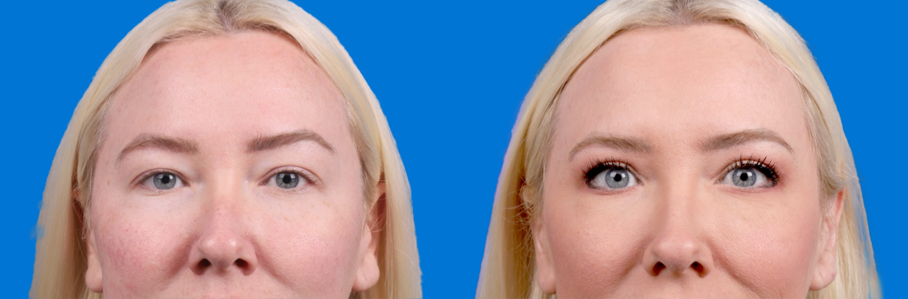 Eyelid Surgery Before & After Gallery - Patient 250007 - Image 1