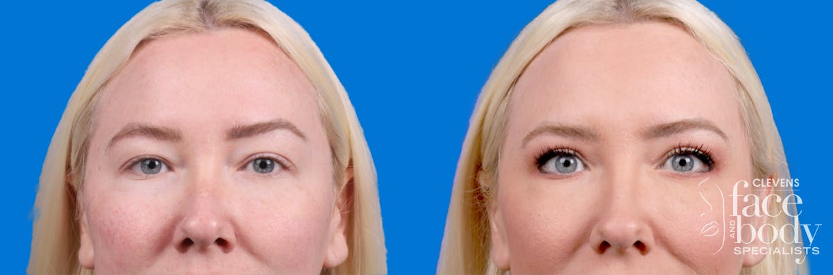 Eyelid Surgery Before & After Gallery - Patient 250007 - Image 2