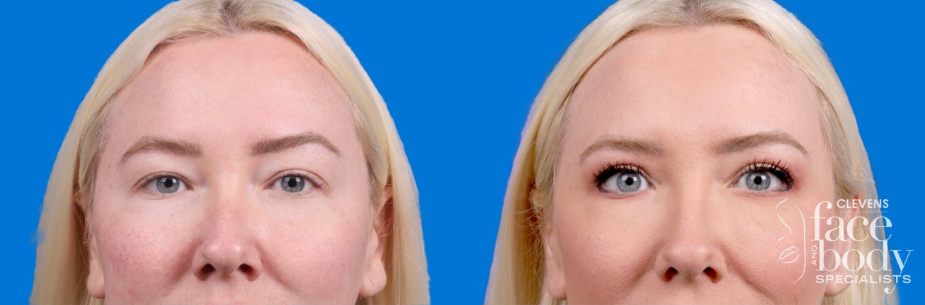 Eyelid Surgery Before & After Gallery - Patient 250007 - Image 2