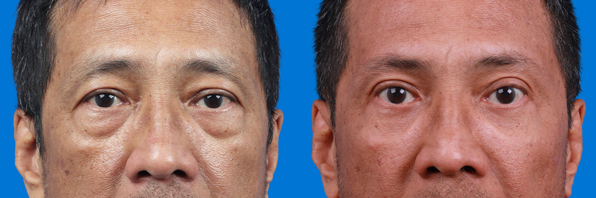 Eyelid Surgery Before & After Gallery - Patient 313372 - Image 1