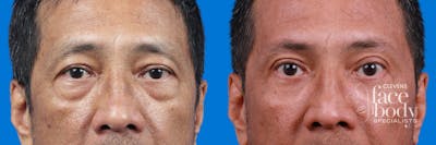 Eyelid Surgery Before & After Gallery - Patient 313372 - Image 1