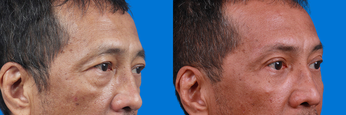 Eyelid Surgery Before & After Gallery - Patient 313372 - Image 2