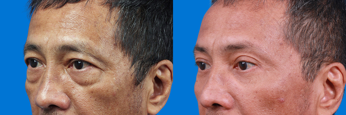 Eyelid Surgery Before & After Gallery - Patient 313372 - Image 3
