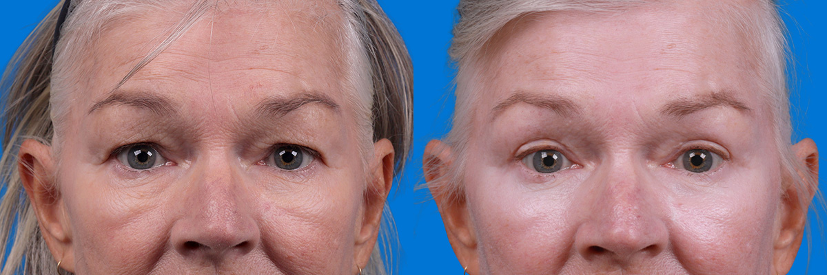 Eyelid Surgery Before & After Gallery - Patient 102056 - Image 1