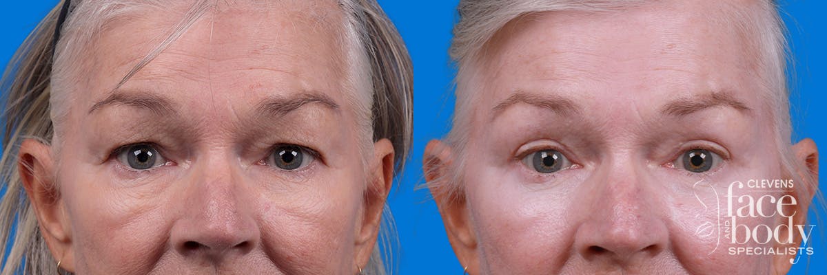 Eyelid Surgery Before & After Gallery - Patient 102056 - Image 1