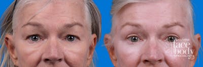 Eyelid Surgery Before & After Gallery - Patient 102056 - Image 1