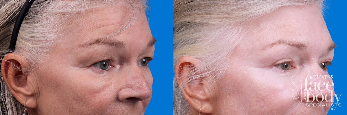 Eyelid Surgery Before & After Gallery - Patient 102056 - Image 2