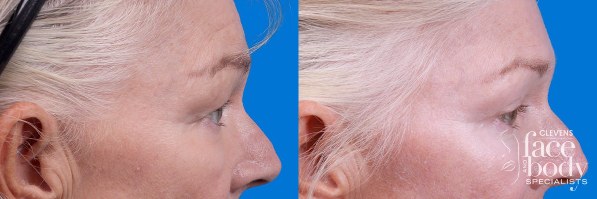 Eyelid Surgery Before & After Gallery - Patient 102056 - Image 3