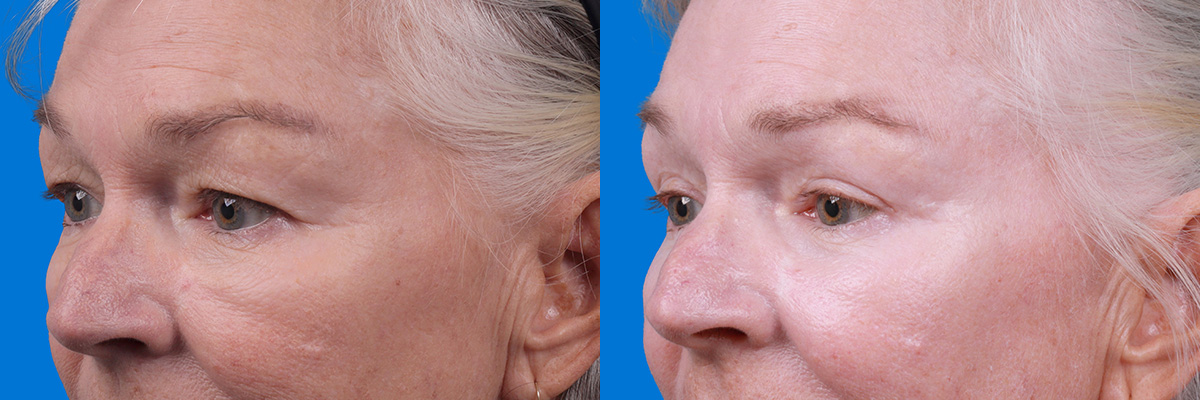 Eyelid Surgery Before & After Gallery - Patient 102056 - Image 4