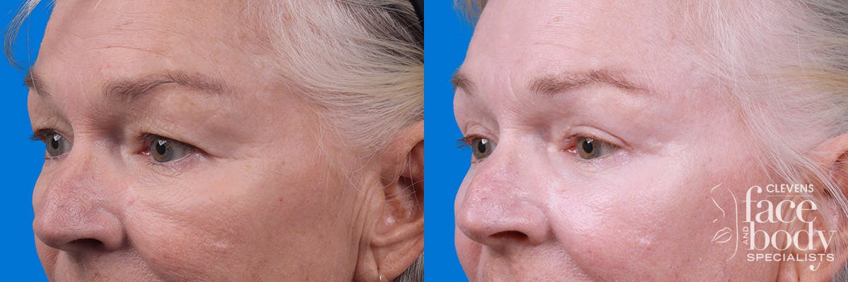 Eyelid Surgery Before & After Gallery - Patient 102056 - Image 4