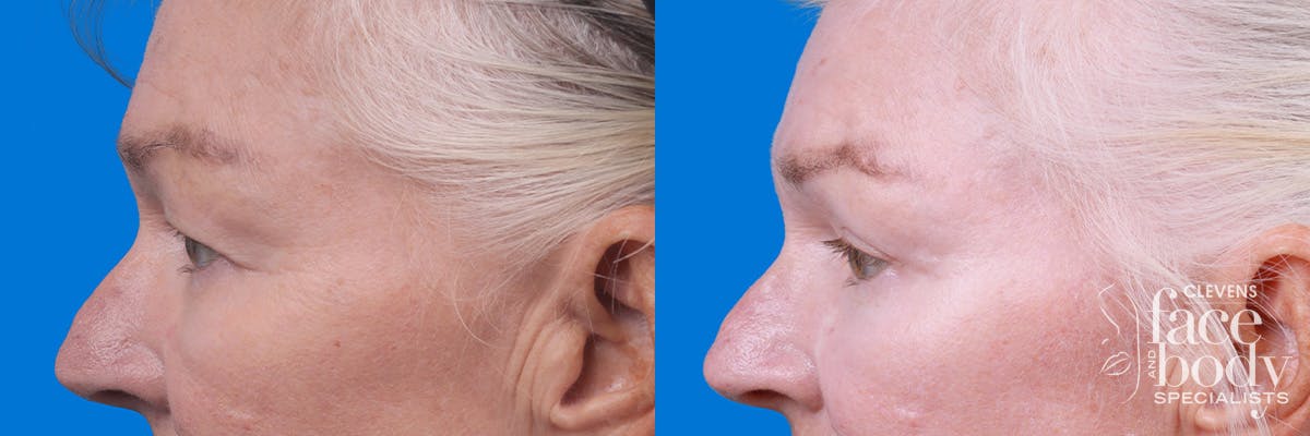 Eyelid Surgery Before & After Gallery - Patient 102056 - Image 5