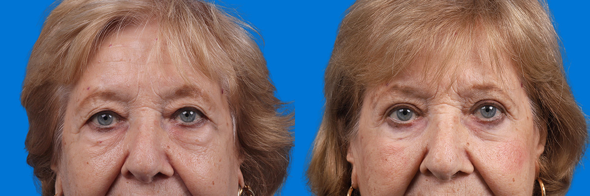 Eyelid Surgery Before & After Gallery - Patient 649413 - Image 1