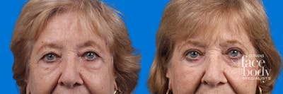 Eyelid Surgery Before & After Gallery - Patient 649413 - Image 1