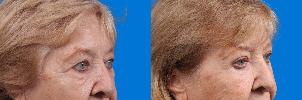 Eyelid Surgery Before & After Gallery - Patient 649413 - Image 2