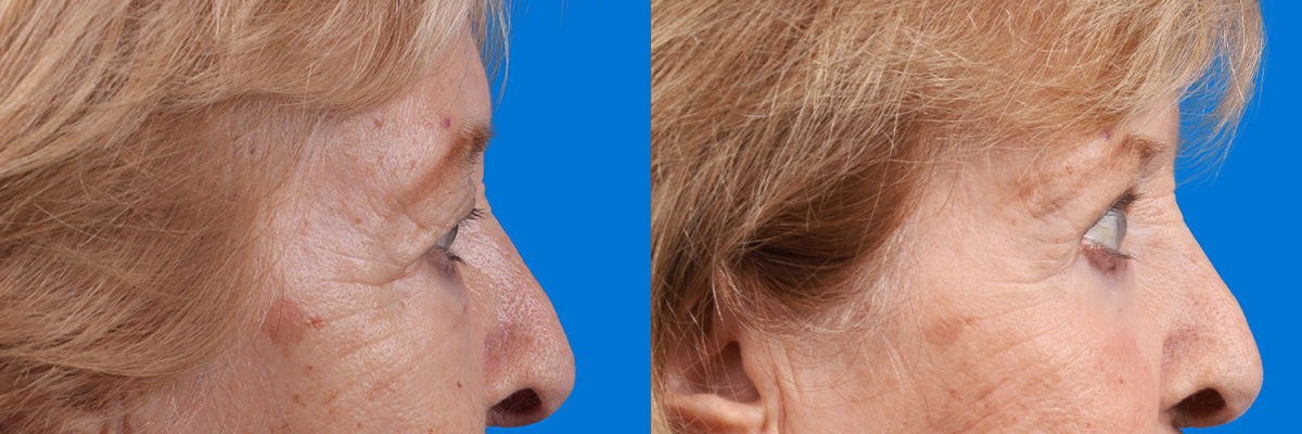 Eyelid Surgery Before & After Gallery - Patient 649413 - Image 3