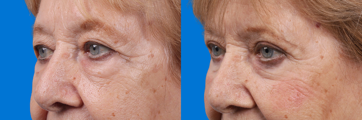 Eyelid Surgery Before & After Gallery - Patient 649413 - Image 4