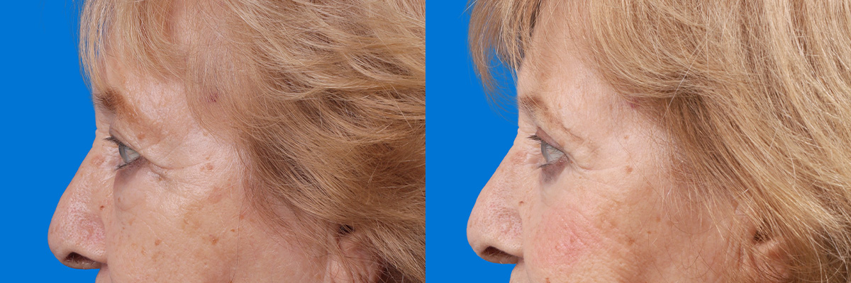 Eyelid Surgery Before & After Gallery - Patient 649413 - Image 5