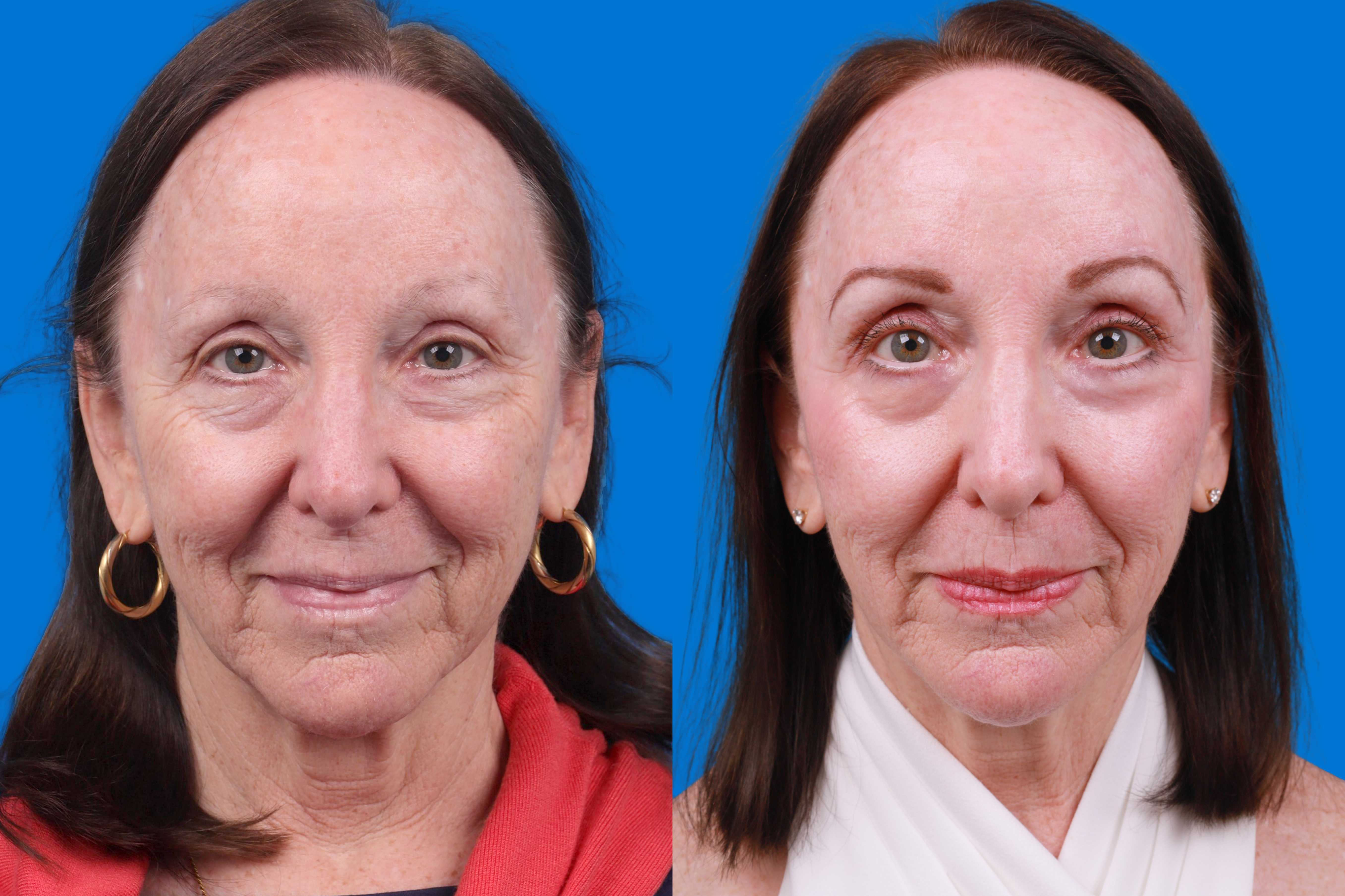 Eyelid Surgery Before & After Gallery - Patient 385532 - Image 1