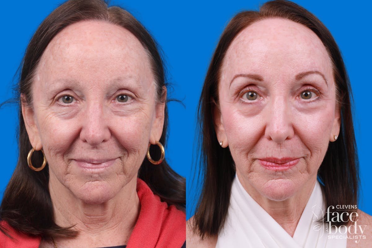 Eyelid Surgery Before & After Gallery - Patient 385532 - Image 1