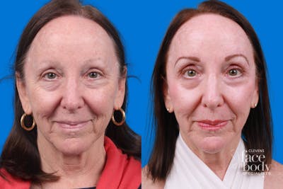 Eyelid Surgery Before & After Gallery - Patient 385532 - Image 1