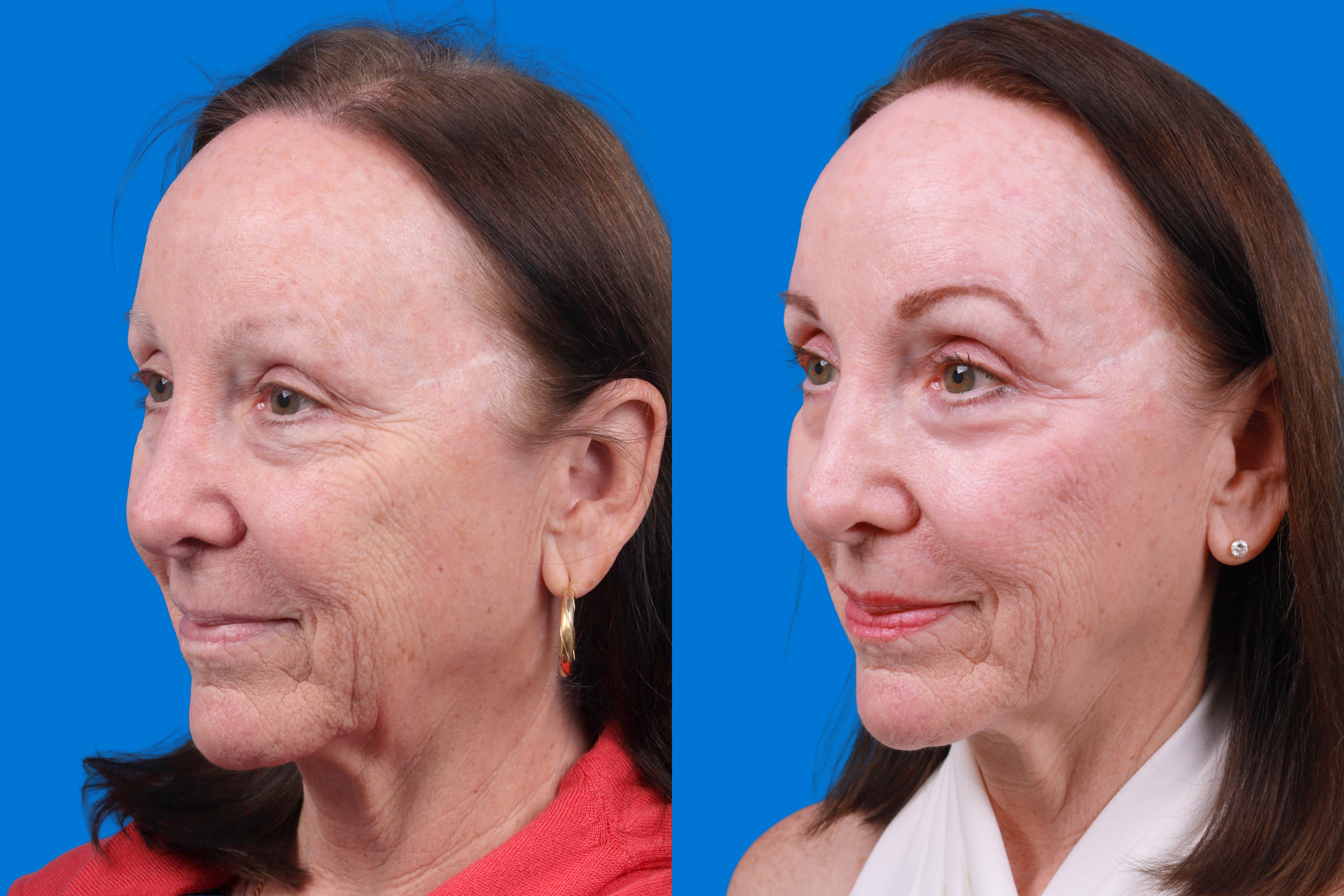 Eyelid Surgery Before & After Gallery - Patient 385532 - Image 3