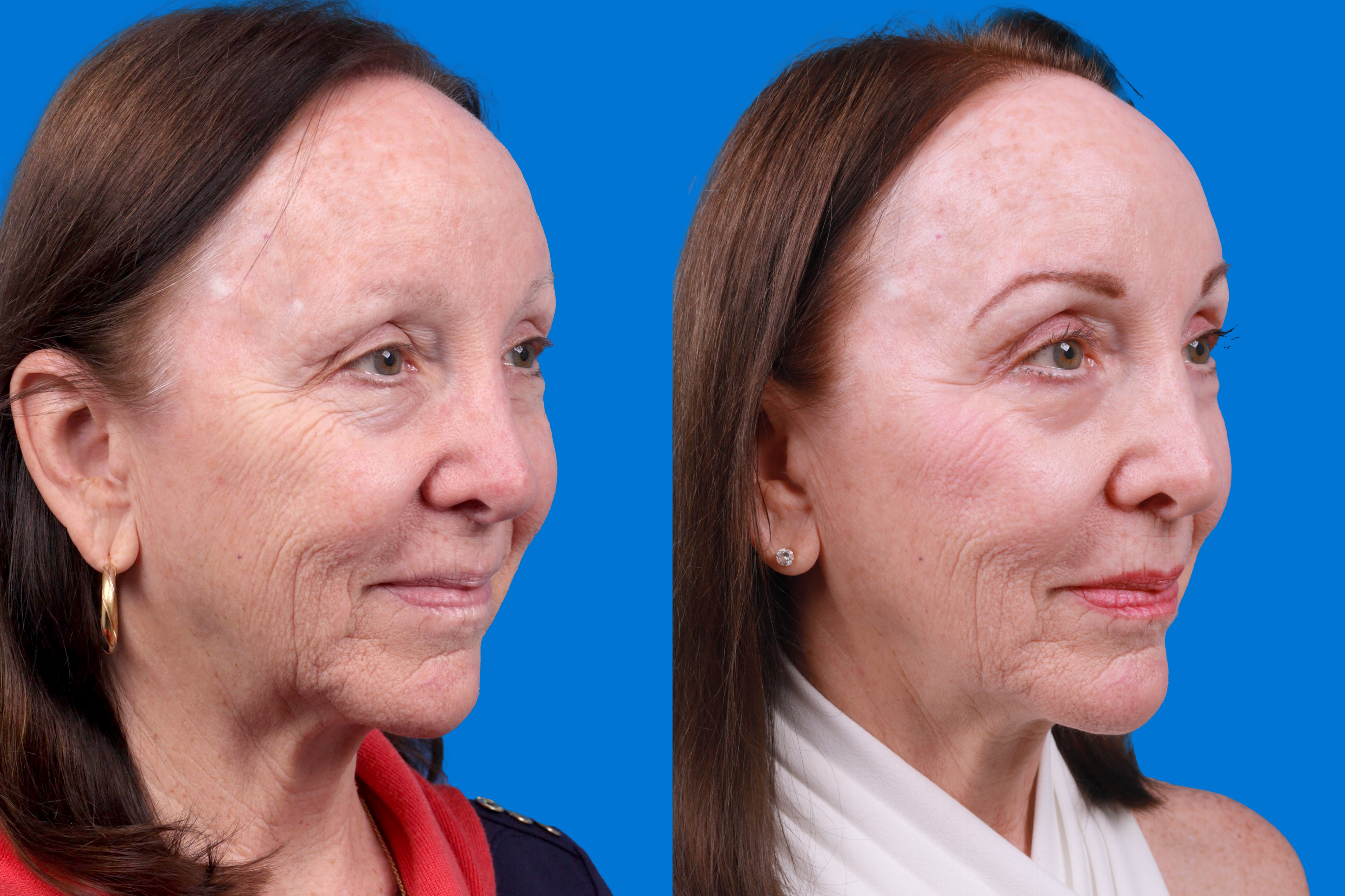 Eyelid Surgery Before & After Gallery - Patient 385532 - Image 2
