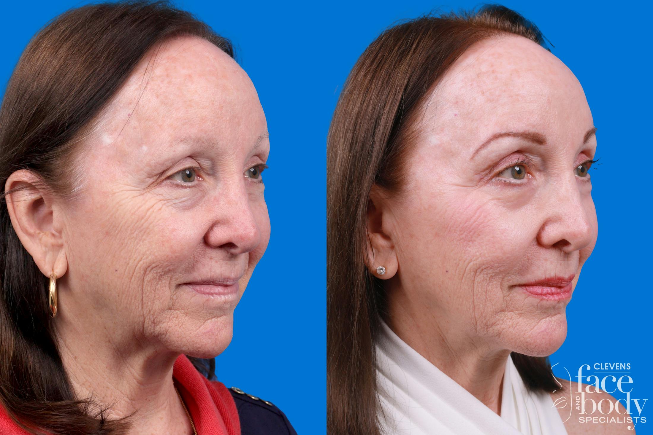 Eyelid Surgery Before & After Gallery - Patient 385532 - Image 2