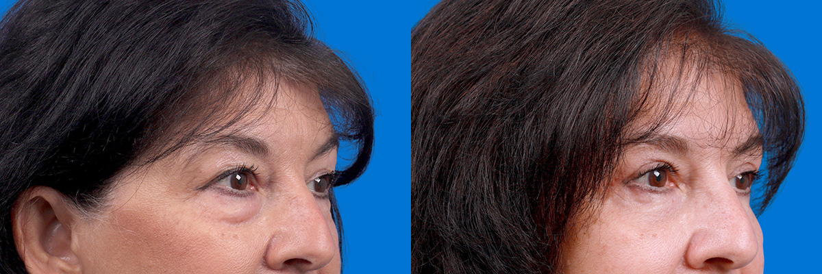 Eyelid Surgery Before & After Gallery - Patient 114068 - Image 2