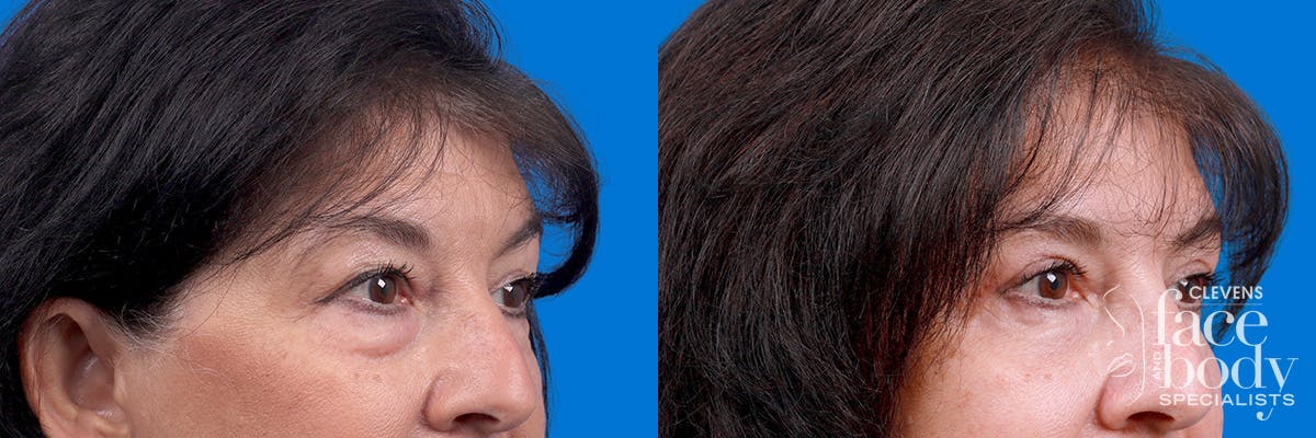 Eyelid Surgery Before & After Gallery - Patient 114068 - Image 2