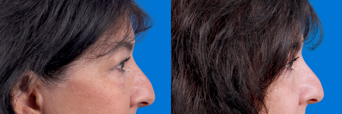 Eyelid Surgery Before & After Gallery - Patient 114068 - Image 3
