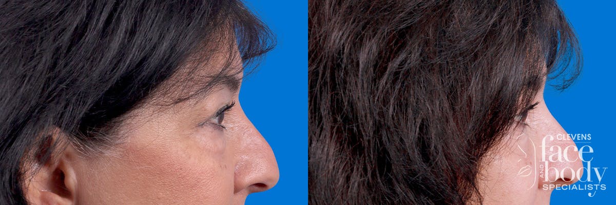 Eyelid Surgery Before & After Gallery - Patient 114068 - Image 3