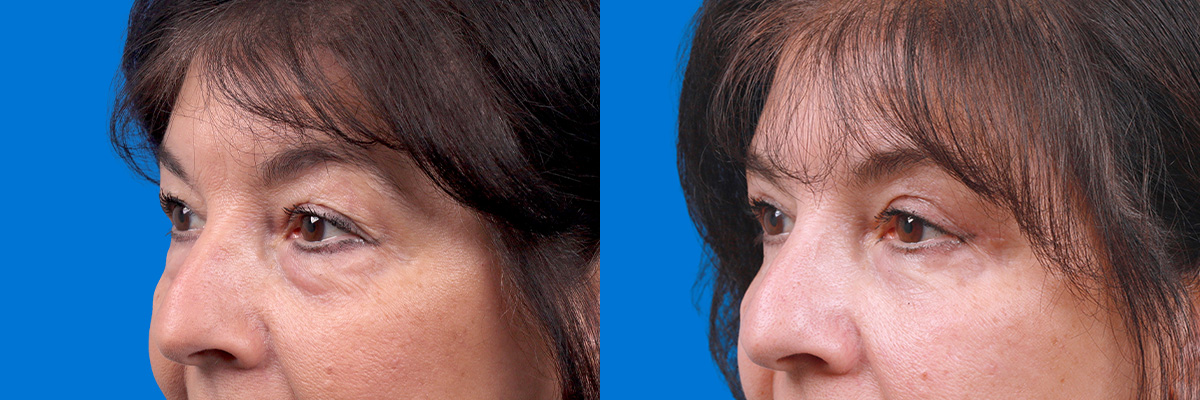 Eyelid Surgery Before & After Gallery - Patient 114068 - Image 4