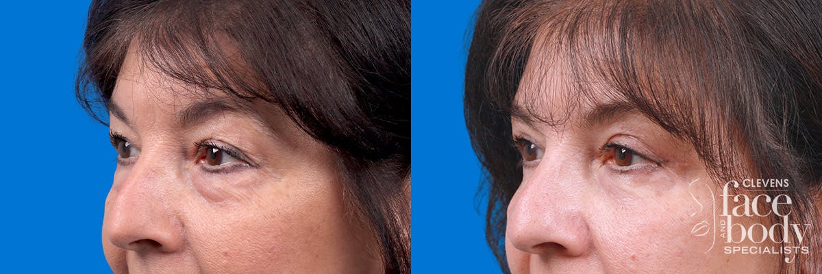 Eyelid Surgery Before & After Gallery - Patient 114068 - Image 4