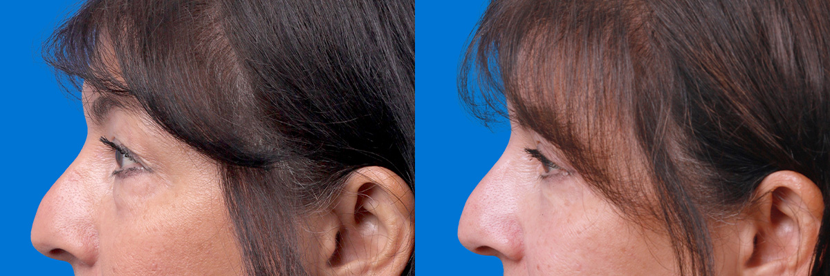 Eyelid Surgery Before & After Gallery - Patient 114068 - Image 5